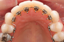 Braces Specialist in Bhopal | Orthodontist in Bhopal