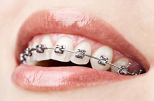 Braces Specialist in Bhopal | Orthodontist in Bhopal