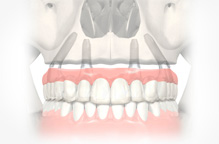 Implants in Bhopal 