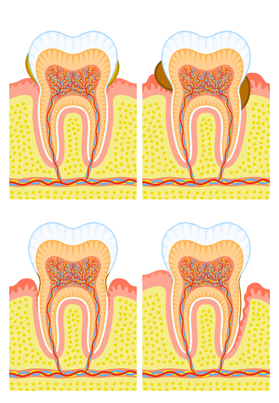 Traditional Implant Treatment