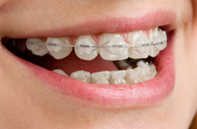 Braces Specialist in Bhopal | Orthodontist in Bhopal