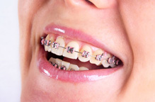 Braces Specialist in Bhopal | Orthodontist in Bhopal 