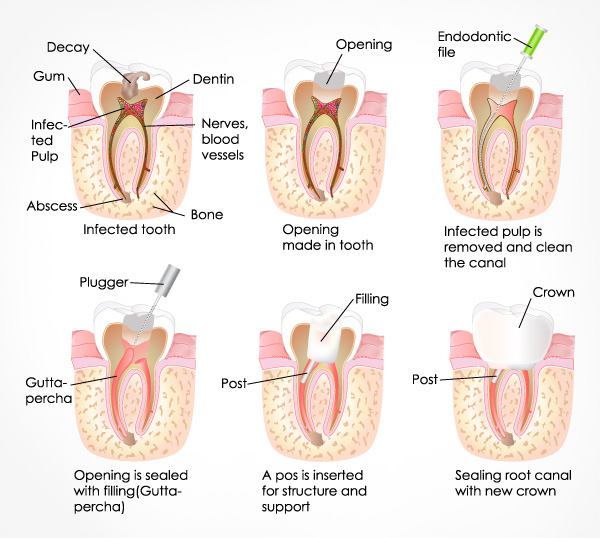 Traditional Implant Treatment